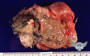Dermoid 1