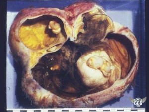 Dermoid 3