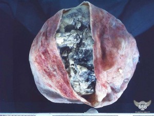 Dermoid 2