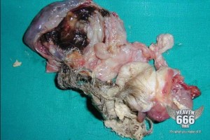Dermoid Cyst #4