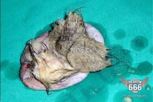 i-hope-you-are-eating-5 Dermoid Cyst #5