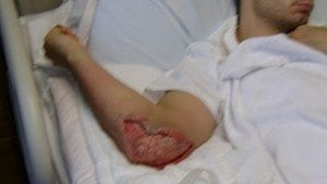 MRSA