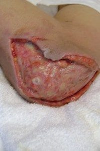 MRSA in the right elbow