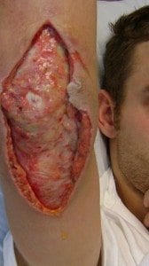 MRSA
