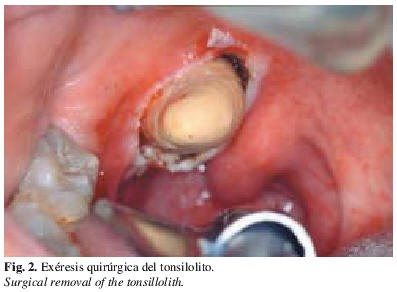 Huge Tonsil Stone Tonsil Stone or He tried to swallow a rock