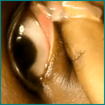 eyecystrelease1 eyecystrelease1