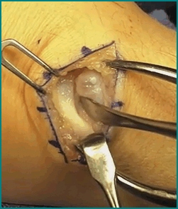 ganglionsurgery1 ganglionsurgery1