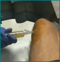 kneeaspiration1 kneeaspiration1