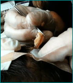 pilarcyst4 pilarcyst4