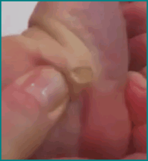 wristganglion2 wristganglion2