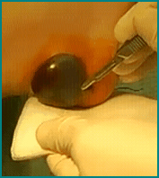 bloodblisterwart1 bloodblisterwart1