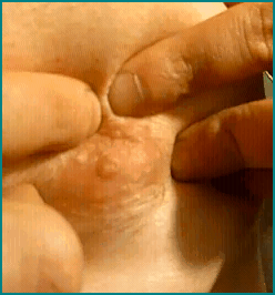 nipplepimple1