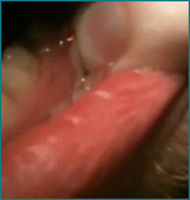 periodontalabscess1 periodontalabscess1