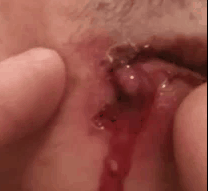 Lipoozestaphinfection1