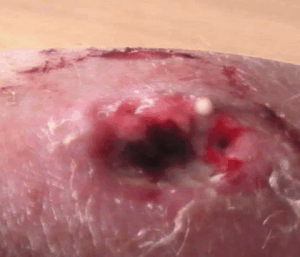 MRSA2 MRSA2