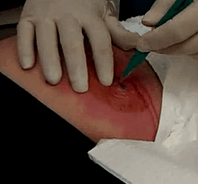 buttabscess1 buttabscess1