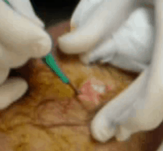 kneecyst1 kneecyst1