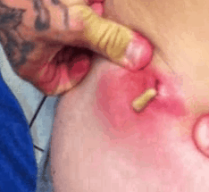 steroidabscess1 steroidabscess1