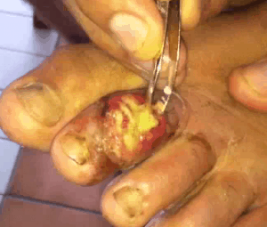 infectedtoe2