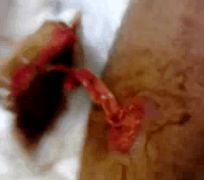 nastywoundpacking1