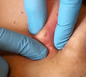 HCcyst2pt3one HCcyst2pt3one