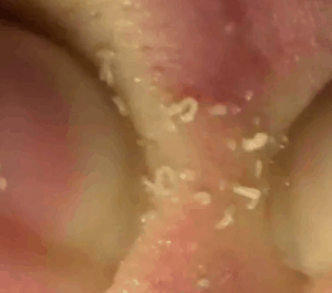 blackheadsguy1
