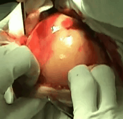 giantlipoma1 giantlipoma1