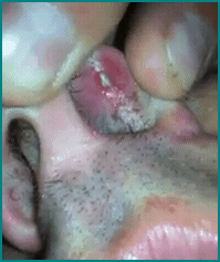 insidenosepimple1 insidenosepimple1