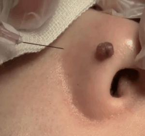 nosewart1 nosewart1