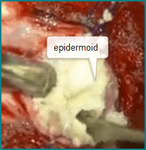 spinalsurgery spinalsurgery