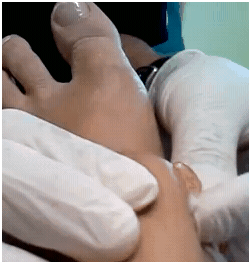 footganglion2