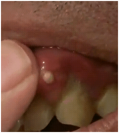 gumabscessfromcigburn1 gumabscessfromcigburn1