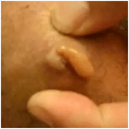spiderbitekneepus1 spiderbitekneepus1
