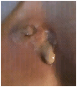 backinfection1