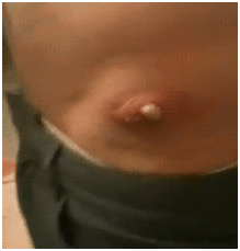dealingwithhugespiderbite1 dealingwithhugespiderbite1