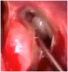 endoprimaryDCR1 endoprimaryDCR1