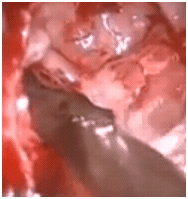 removingpuscystfromsinus1 removingpuscystfromsinus1