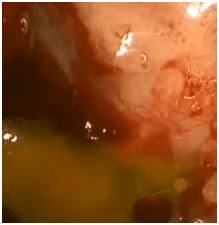 sphenoidleak1 sphenoidleak1