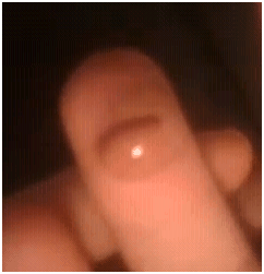 MRSAfingerblister2 MRSAfingerblister2