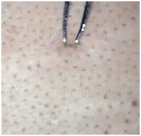 backblackheads1 backblackheads1