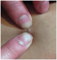 bacneblackhead1 bacneblackhead1