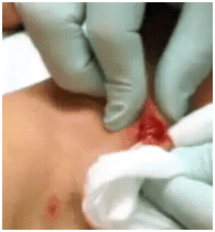 gnarlyarmpitabscess1 gnarlyarmpitabscess1