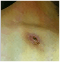 grossabscess1