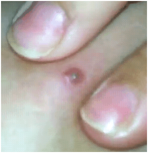 nastypimple1
