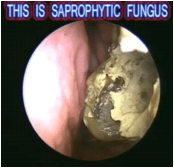 saprophyticfungus1