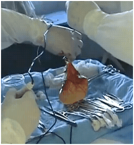 thoracicsurgeryingeorgia2 thoracicsurgeryingeorgia2