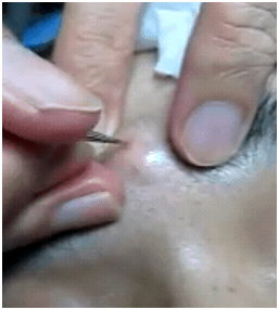 JapaneseAcneTreatment1