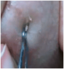 asianextractiontechnique2 asianextractiontechnique2
