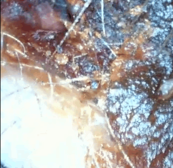 earwaxremoval1 earwaxremoval1