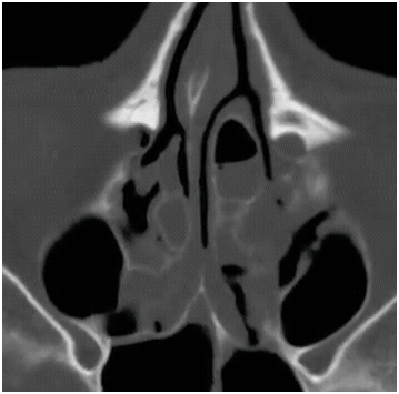 ethmoidectomy1 ethmoidectomy1